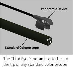 Panoramic Device and Standard Colonoscope.jpg