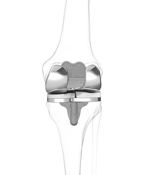 iTotal CR total knee replacement