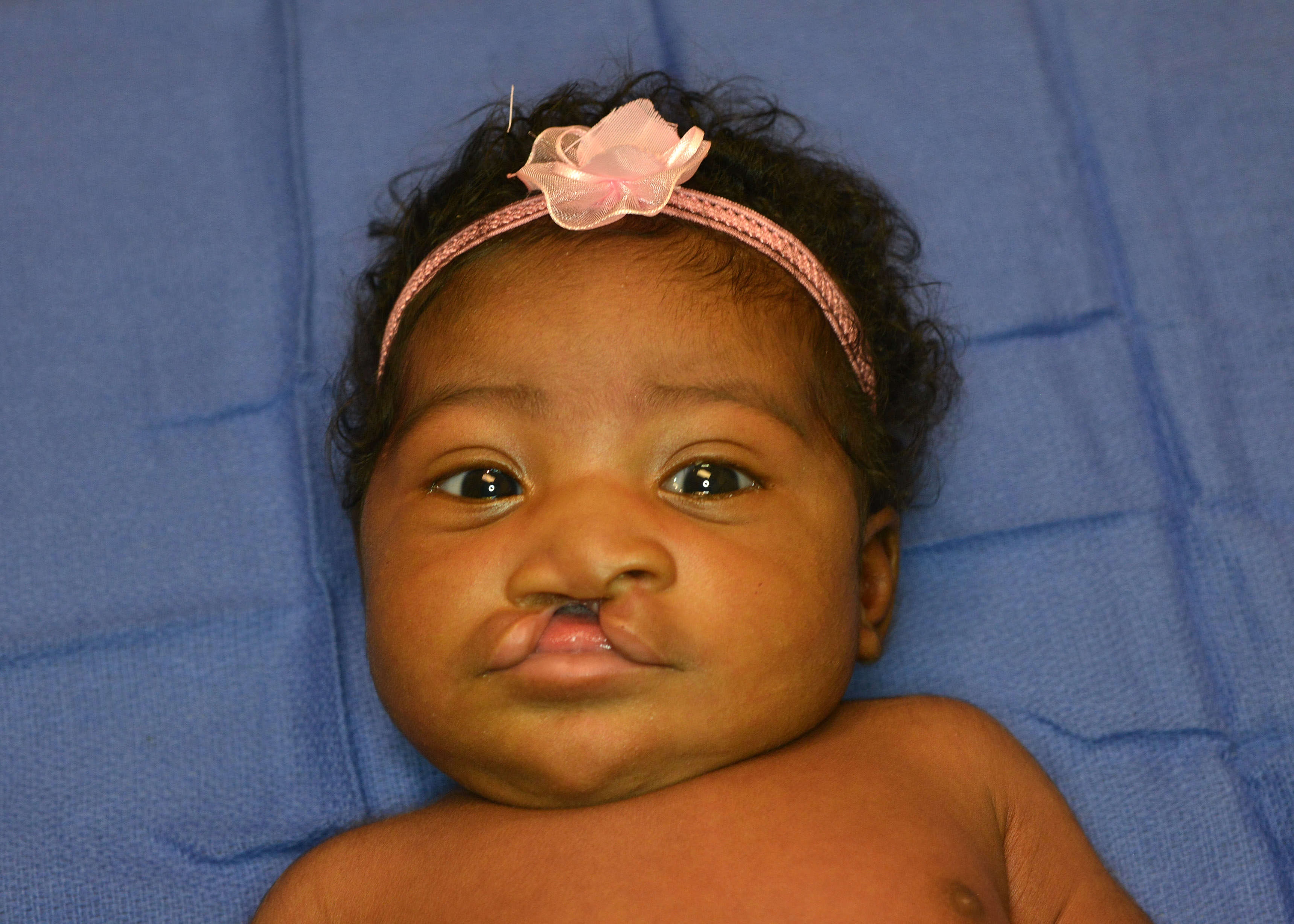 Cleft lip and cleft palate are openings or splits in the upper lip, the roof of the mouth (palate) or both. Cleft lip and cleft palate result when facial structures that are developing in an unborn baby don't close completely.