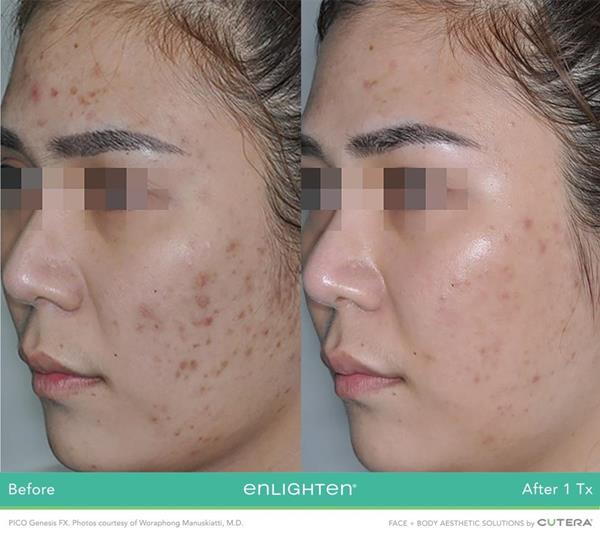 Cutera Inc.’s enlighten ©®️ Laser Platform Now Indicated For Acne Scars
