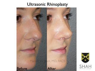 ultrasonic-rhinoplasty.002
