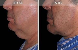 Wattlectomy Before & After By Dr. Antell
