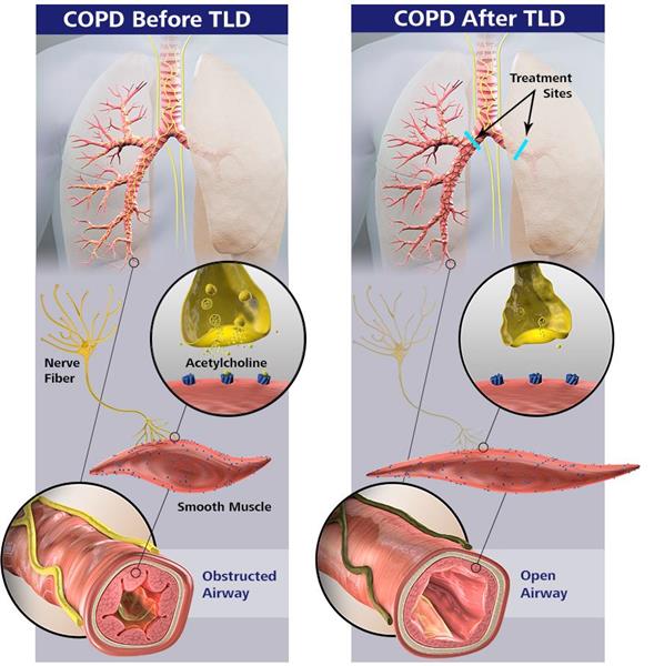 COPD before and after TLD with Nuvaira system.