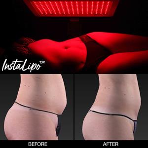 InstaLipo Before And After Image