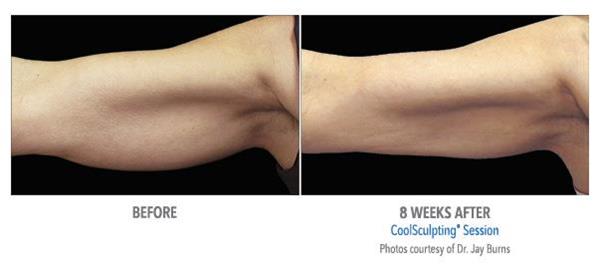 CoolSculpting Treatment Before and After Photos
