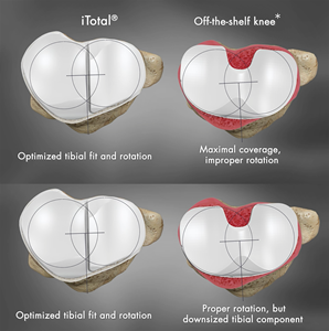 Optimized tibial fit and rotation: Conformis versus off-the-shelf