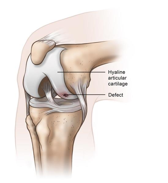Knee Cartilage Damage