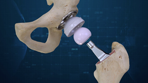 New Conformis 3D Designed Hip Replacement Implant