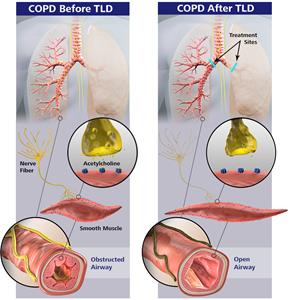 COPD before and after Targeted Lung Denervation